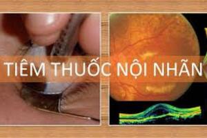 Bệnh viện Mắt tỉnh triển khai kỹ thuật tiêm nội nhãn điều trị một số bệnh về mắt