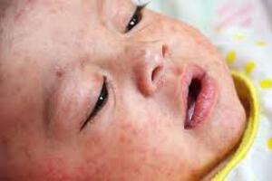 TÌM HIỂU VỀ BỆNH SỞI