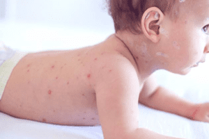 TÌM HIỂU VỀ BỆNH SỞI