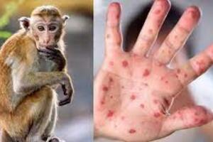 Hướng dẫn chẩn đoán, điều trị và phòng bệnh đậu mùa khỉ ở người.