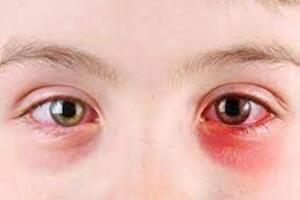 Bệnh đau mắt đỏ đang gia tăng, cần làm gì để phòng bệnh?