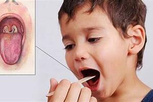 Những điều cần biết về bệnh bạch hầu