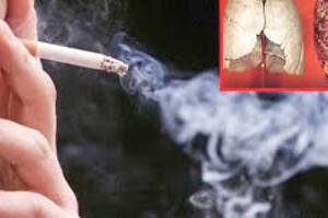 Hút thuốc lá chiếm đến 97% nguyên nhân gây ra ung thư phổi
