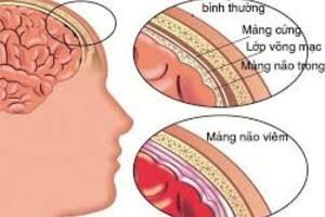 Viêm màng não do não mô cầu, mối nguy hiểm tiềm ẩn trong cộng đồng