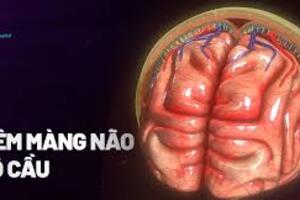 BỆNH VIÊM MÀNG NÃO DO NÃO MÔ CẦU (Meningitis meningococcuso)