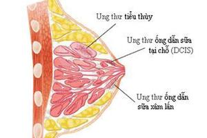 Phát hiện sớm ung thư vú - Chìa khóa giảm tỷ lệ tử vong ở phụ nữ