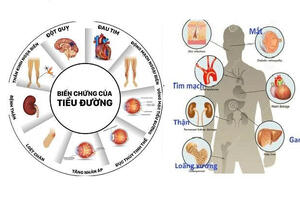 Chủ động phòng ngừa, tầm soát bệnh đái tháo đường
