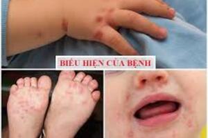 Tìm hiểu về bệnh chân tay miệng