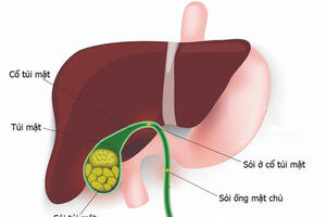 Cách để có một túi mật khỏe mạnh và phòng ngừa sỏi mật