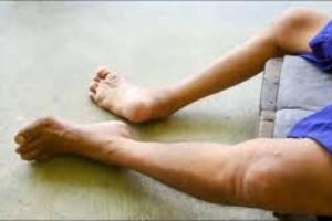 Tăng cường tiêm chủng vắc xin và chủ động triển khai các biện pháp phòng, chống bệnh bại liệt