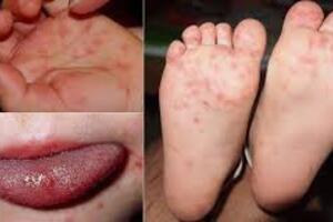 Bệnh tay chân miệng dùng thuốc như thế nào?