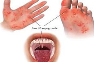 Những biến chứng đáng sợ của bệnh tay chân miệng
