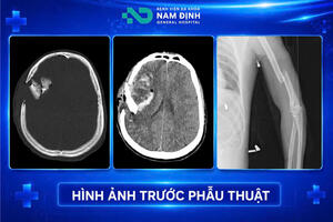 CẤP CỨU THÀNH CÔNG NGƯỜI BỆNH CHẤN THƯƠNG SỌ NÃO NGUY KỊCH KHÔNG CÓ NGƯỜI NHÀ ĐI CÙNG