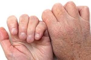 Phòng tránh tình trạng khô nẻ da vào mùa đông