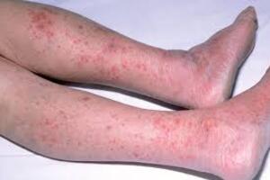 Phòng chống bệnh do não mô cầu