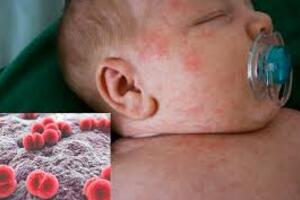 Cách nhận biết sớm bệnh viêm não mô cầu ở trẻ em và phương pháp xử trí