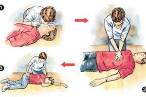 Những lưu ý khi cấp cứu người ngạt nước, đuối nước