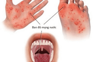 BỆNH TAY CHÂN MIỆNG Nguyên nhân, dấu hiệu nhận biết và các biện pháp phòng bệnh