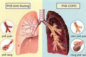 Phương thuốc hay phòng trị bệnh hô hấp mạn tính