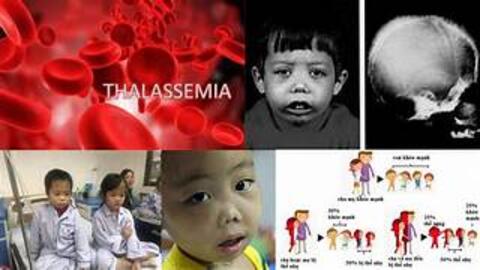 Thalassemia bệnh gì? Ngày Thalassemia thế giới là ngày nào?