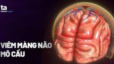 BỆNH VIÊM MÀNG NÃO DO NÃO MÔ CẦU (Meningitis meningococcuso)