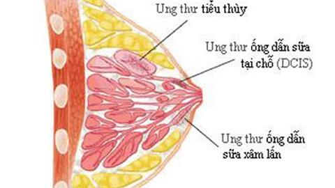 Phát hiện sớm ung thư vú - Chìa khóa giảm tỷ lệ tử vong ở phụ nữ