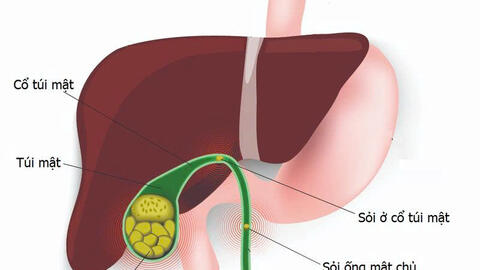 Cách để có một túi mật khỏe mạnh và phòng ngừa sỏi mật
