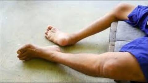 Tăng cường tiêm chủng vắc xin và chủ động triển khai các biện pháp phòng, chống bệnh bại liệt