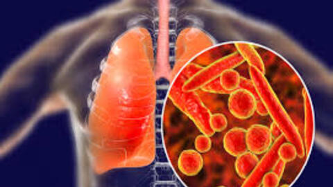 Cách nhận biết mình có bị lao phổi hay không?