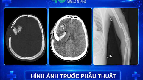 CẤP CỨU THÀNH CÔNG NGƯỜI BỆNH CHẤN THƯƠNG SỌ NÃO NGUY KỊCH KHÔNG CÓ NGƯỜI NHÀ ĐI CÙNG
