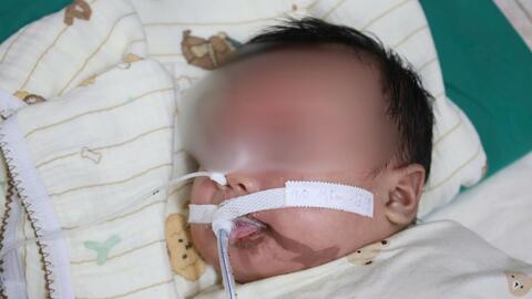 Bệnh viện Sản Nhi tỉnh Ninh Bình cấp cứu thành công trường hợp trẻ 1 tháng tuổi bị người lớn nhỏ nhầm axit vào miệng