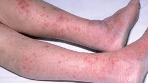 Phòng chống bệnh do não mô cầu