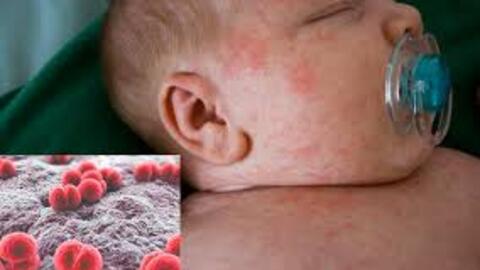 Cách nhận biết sớm bệnh viêm não mô cầu ở trẻ em và phương pháp xử trí