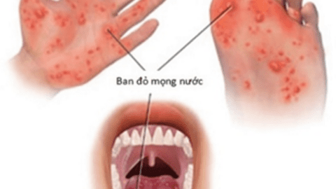 BỆNH TAY CHÂN MIỆNG Nguyên nhân, dấu hiệu nhận biết và các biện pháp phòng bệnh