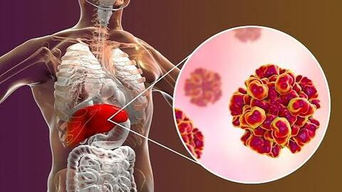 Tìm hiểu về bệnh viêm gan C - chủ động phòng ngừa để bảo vệ sức khỏe