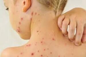 Bệnh thủy đậu và cách phòng tránh