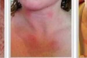 Kháng sinh cefalexin chống nhiễm khuẩn có an toàn?