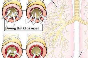 Ngừa hen phế quản ở thai phụ