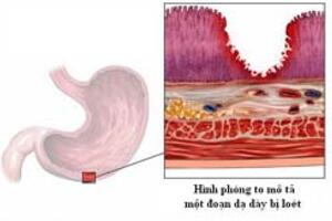 Sử dụng thuốc trong điều trị loét đường tiêu hóa