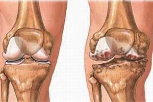 Bệnh thoái hóa khớp và biện pháp phòng chống