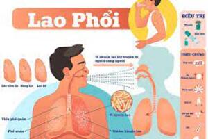 Yếu tố nguy cơ và cách phòng ngừa lao phổi