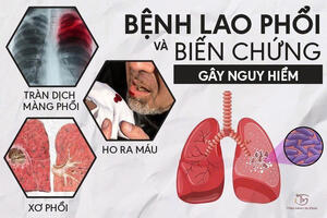 Bệnh Lao và các biện pháp phòng, chống