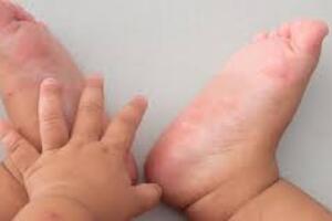 7 cách phòng bệnh tay chân miệng ở trẻ em