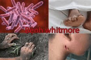 Bệnh Whitmore và công tác triển khai phòng chống bệnh tại tỉnh Ninh Bình