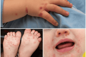 Thời tiết nóng ẩm tạo điều kiện cho mầm bệnh tay chân miệng lưu hành