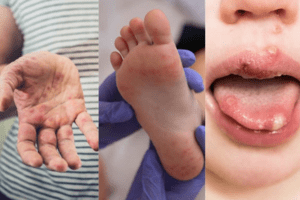 Chủ động phòng, chống bệnh tay chân miệng tại các cơ sở giáo dục