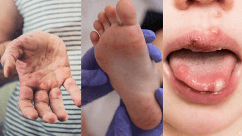 Chủ động phòng, chống bệnh tay chân miệng tại các cơ sở giáo dục