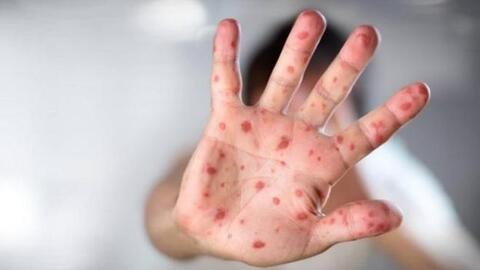 Tăng cường phòng chống bệnh tay chân miệng